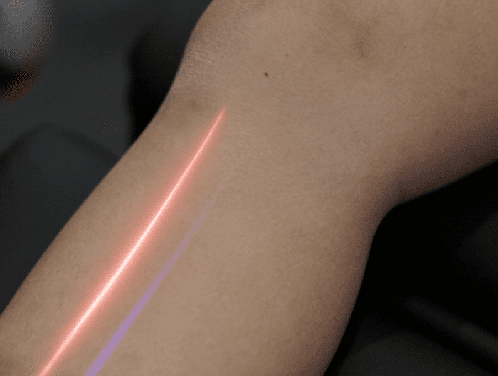 Cold-Laser-For-Pain