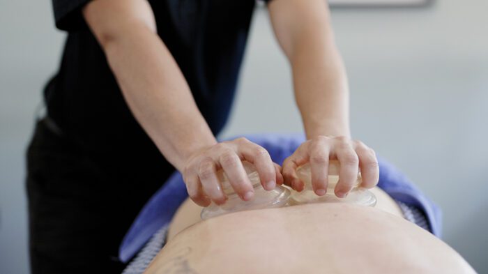 Cupping in Newcastle