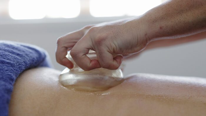 Cupping in Newcastle